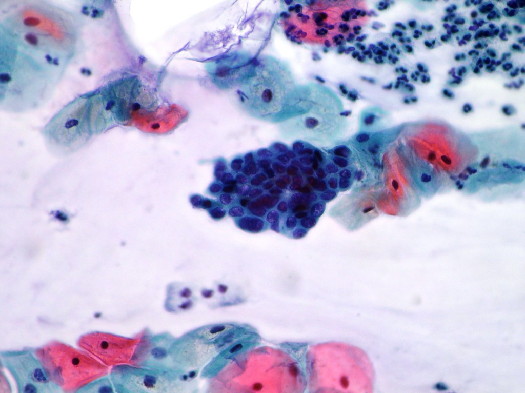 Point. abnormal glandular pap smear in vagina the talented Abnormal glandular pap smear in vagina late