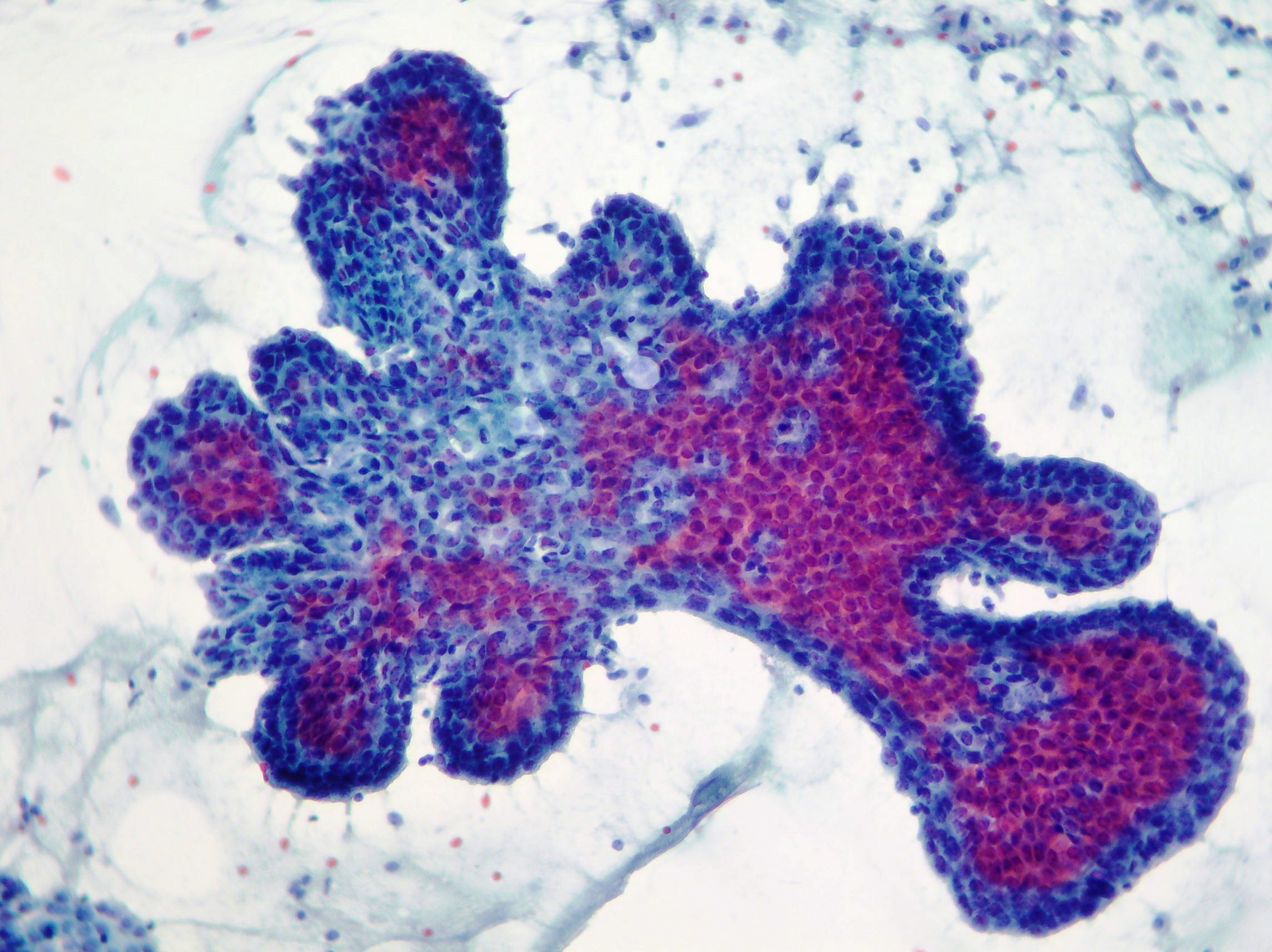 ductal papilloma cytology)