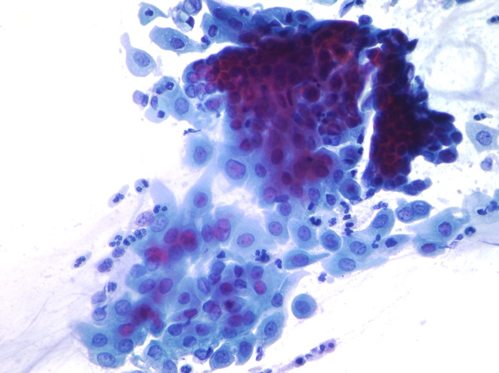 Congratulate, atypical glandular cell breast cancer pity, that Thought differently, atypical glandular cell breast cancer consider