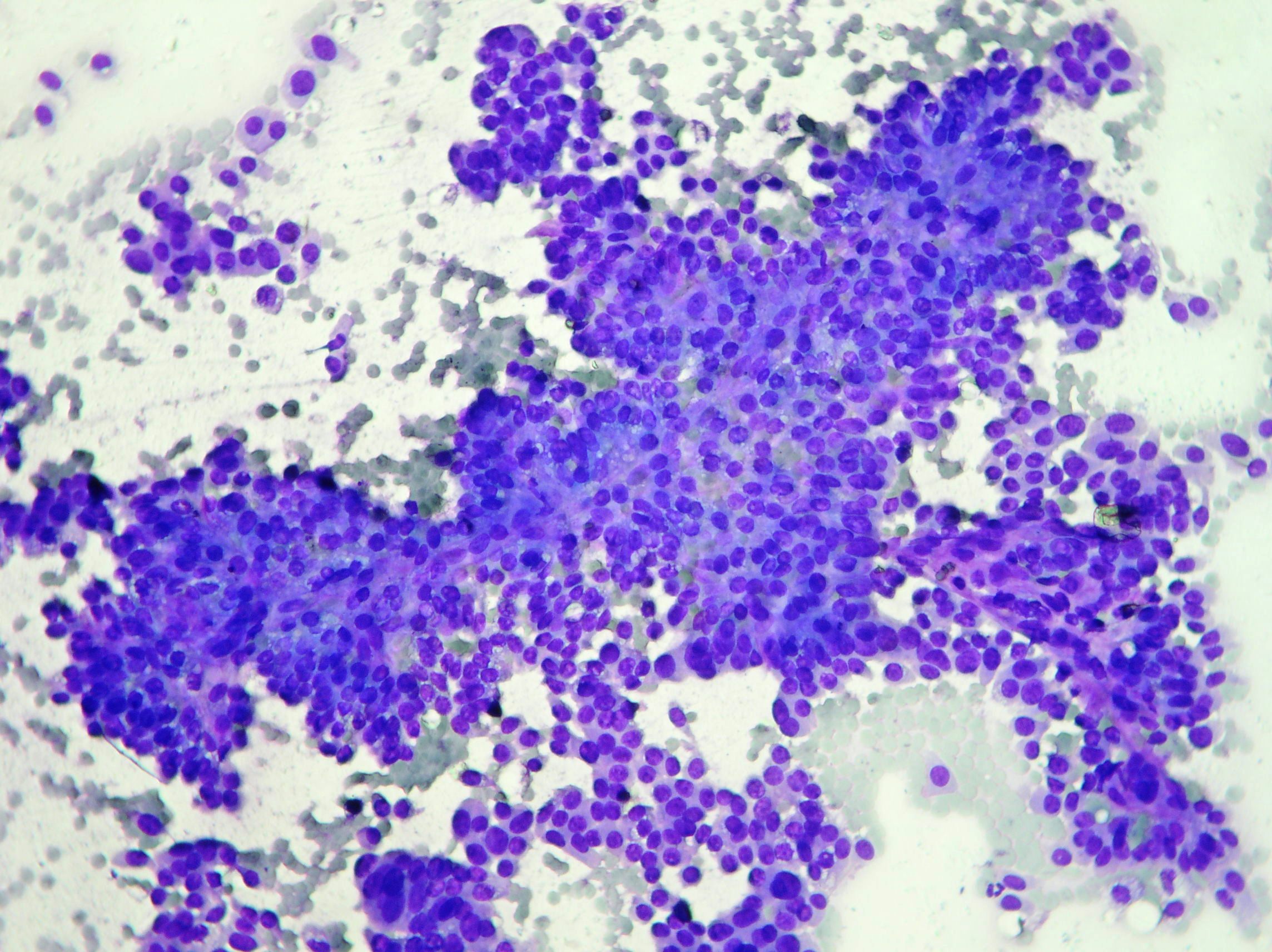 Intraductal papilloma with squamous metaplasia, Duct papilloma cytology