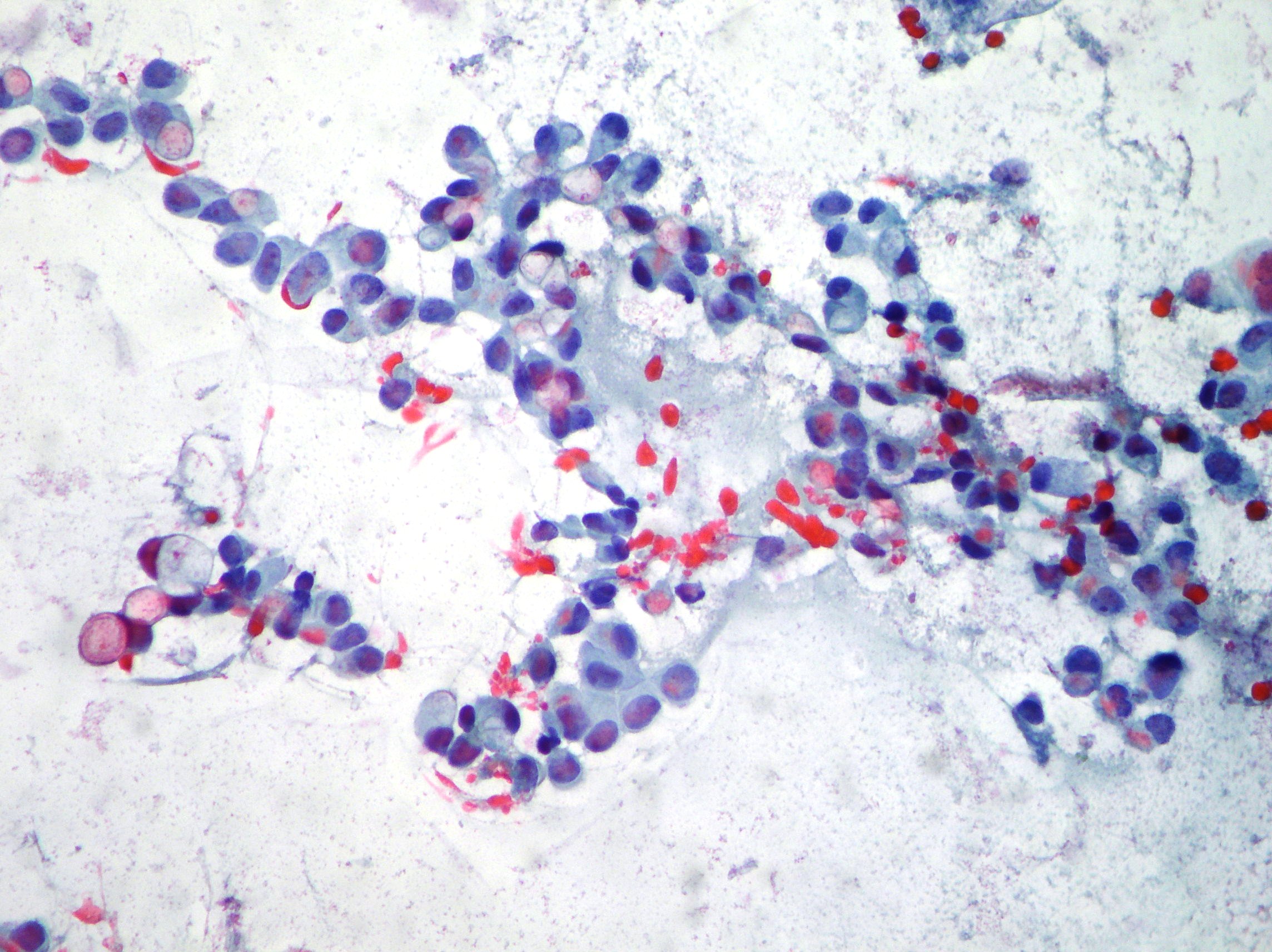 File:Fibrocystic changes of breast - cytology 1.jpg 