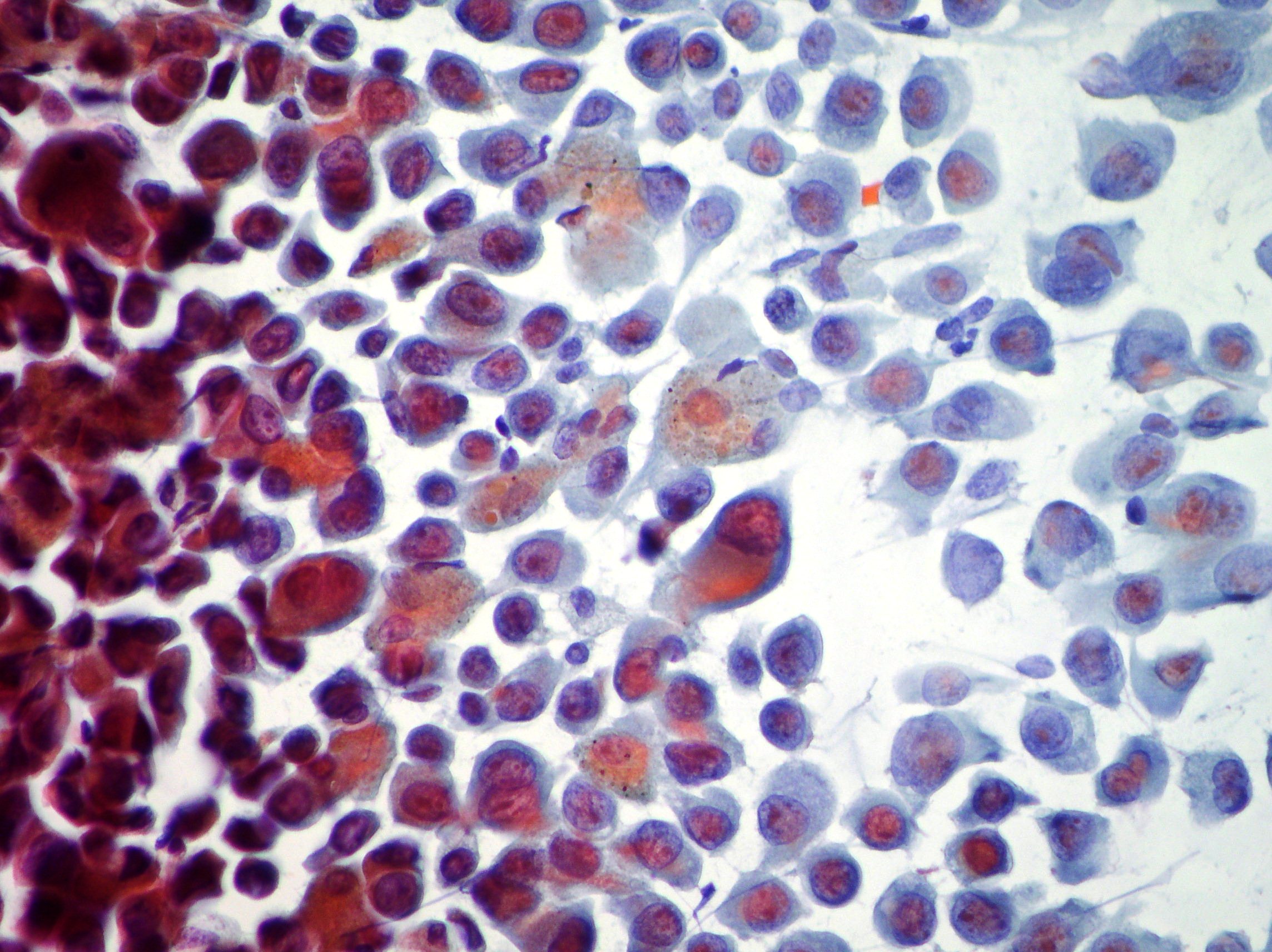  Lung adenocarcinoma