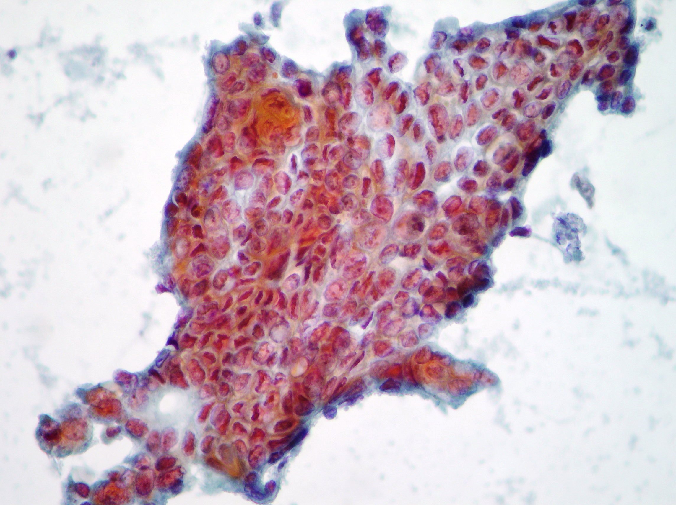 Pancreatic adenocarcinoma