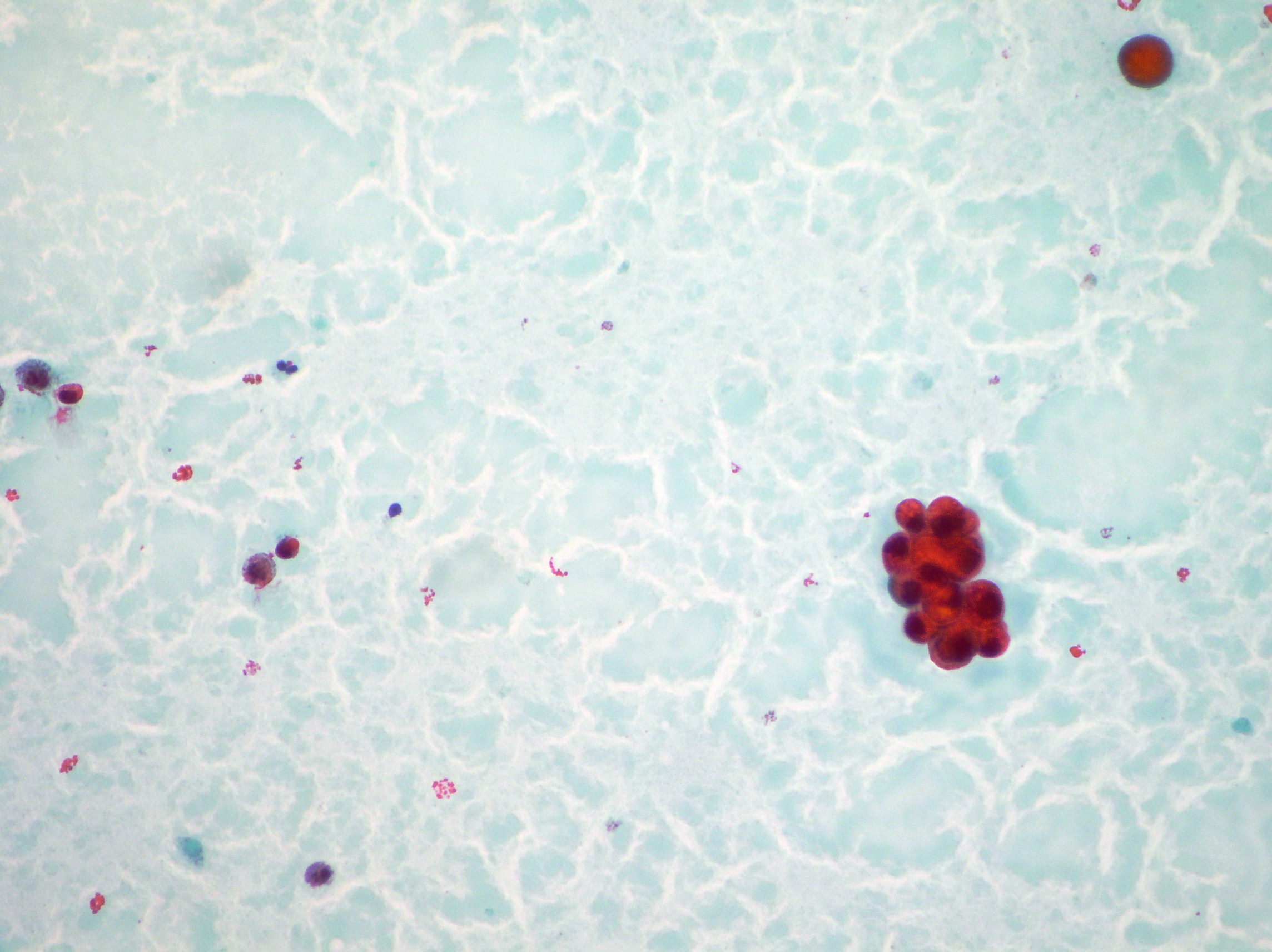 Breast Cytopathology Cellnetpathology