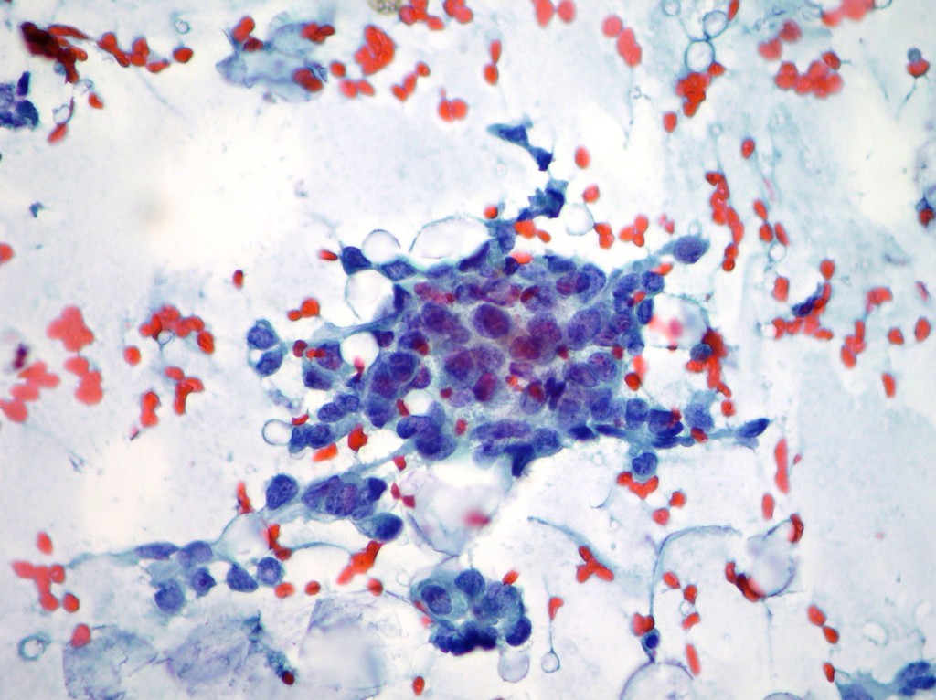 Breast Cytopathology