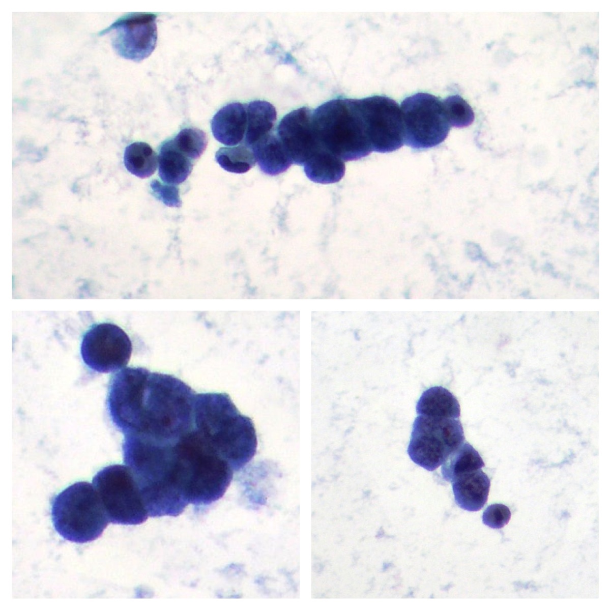 microcitoma pleural effusion