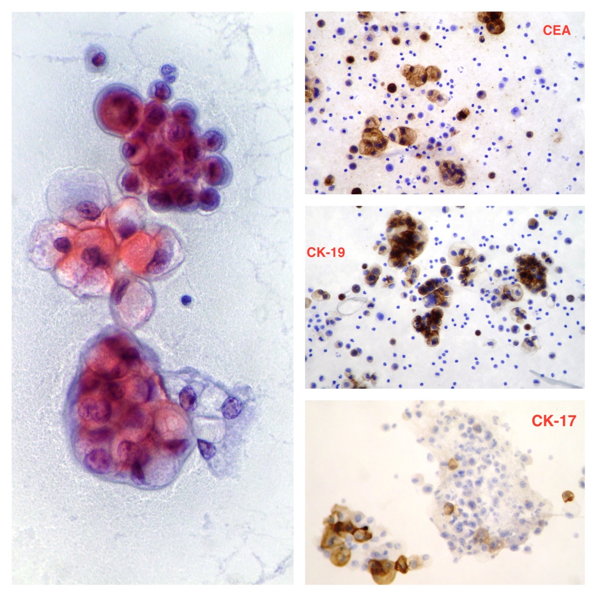 pancreatic cells, abdominal effusion CEA, CK-19, CK-17