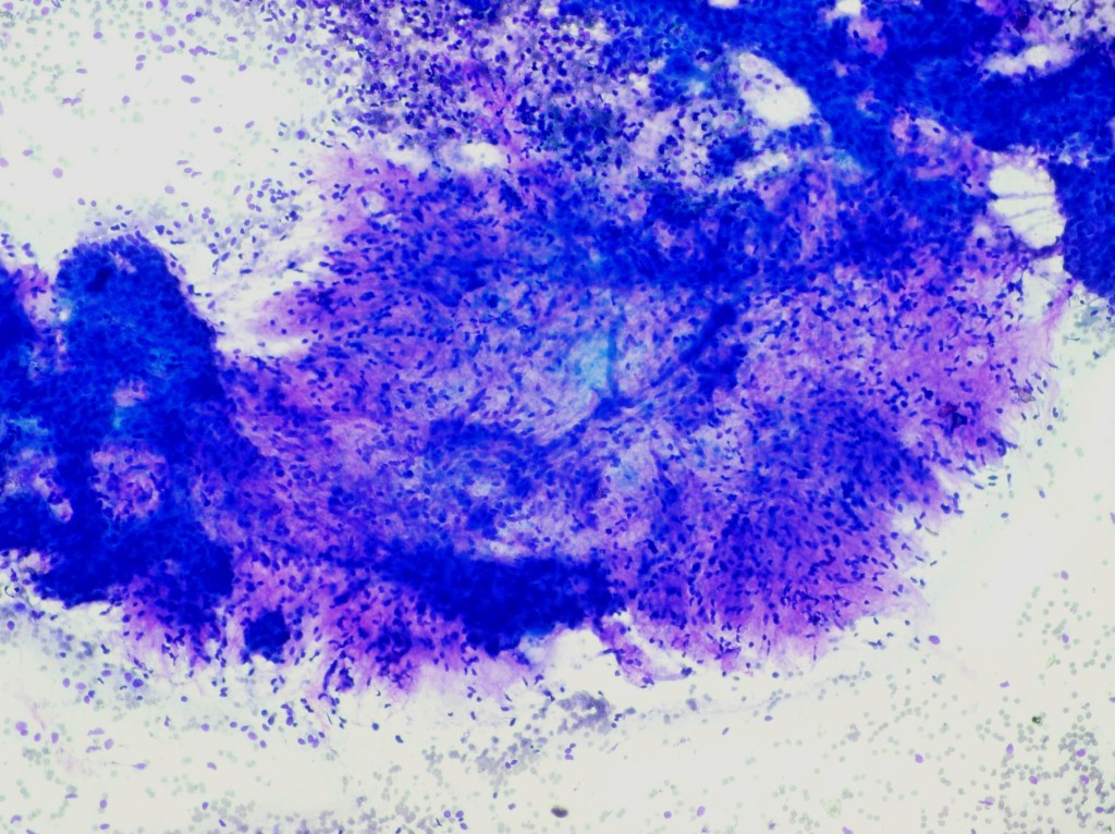 Breast Cytopathology