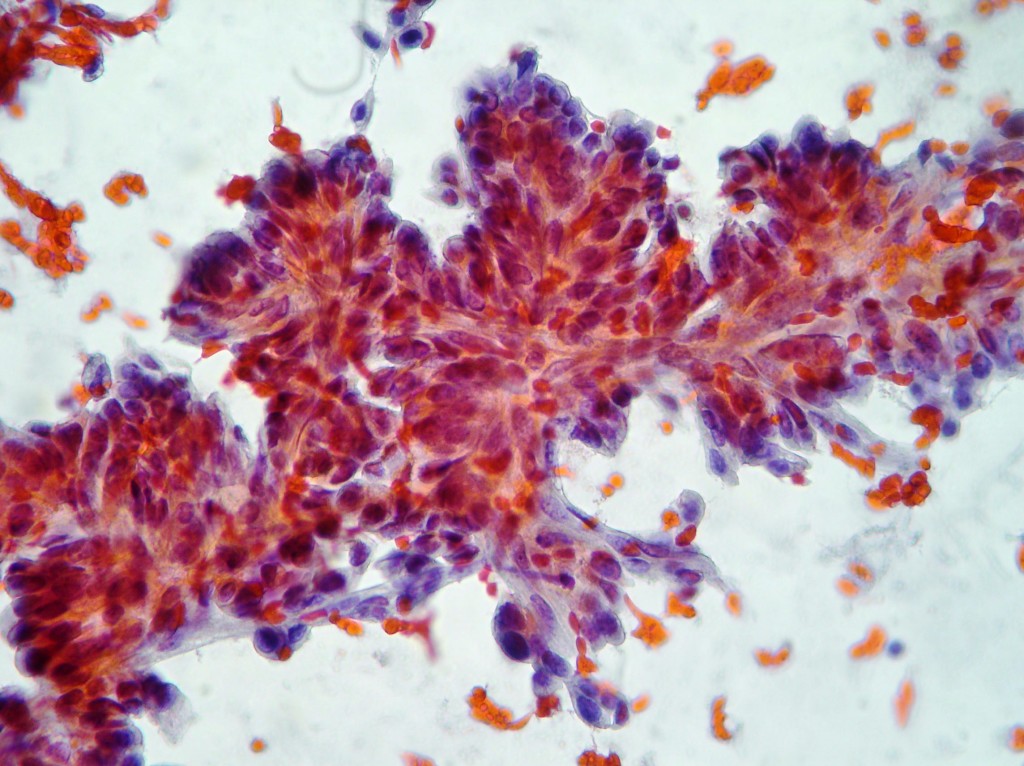 Ductal breast carcinoma