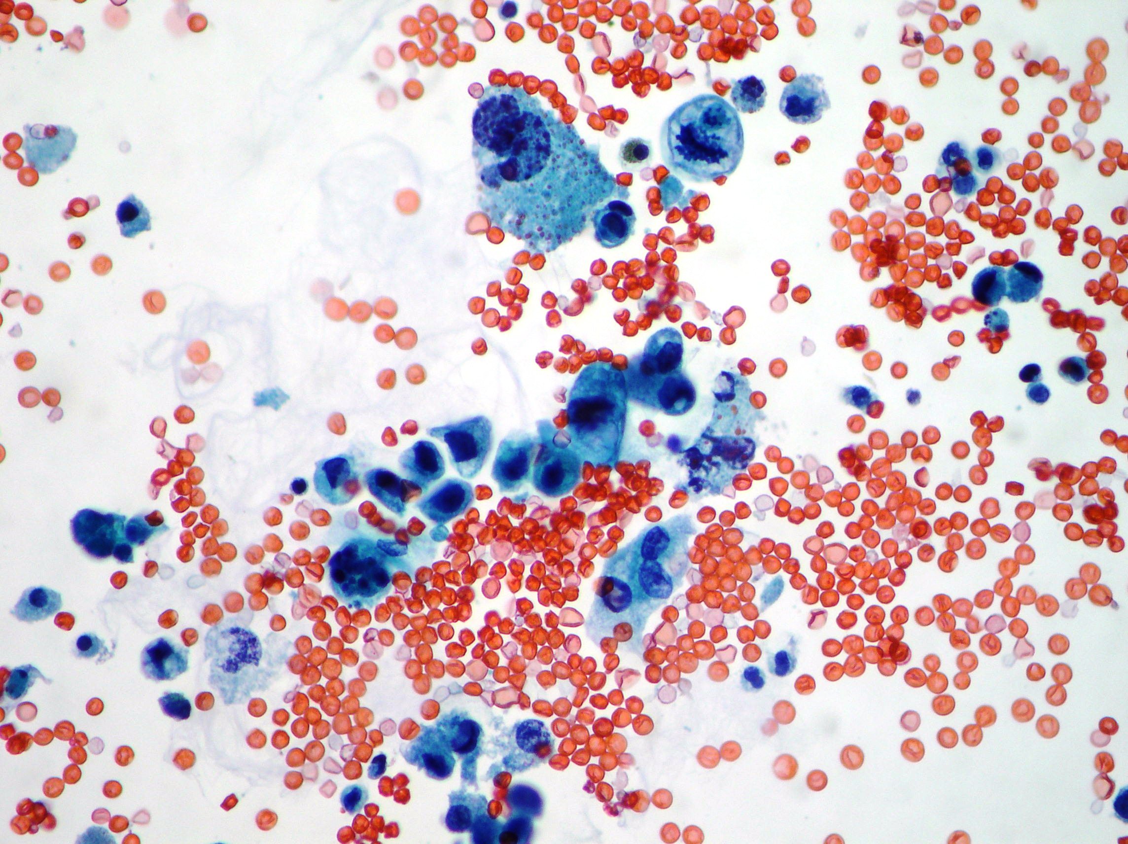 Urothelial carcinoma