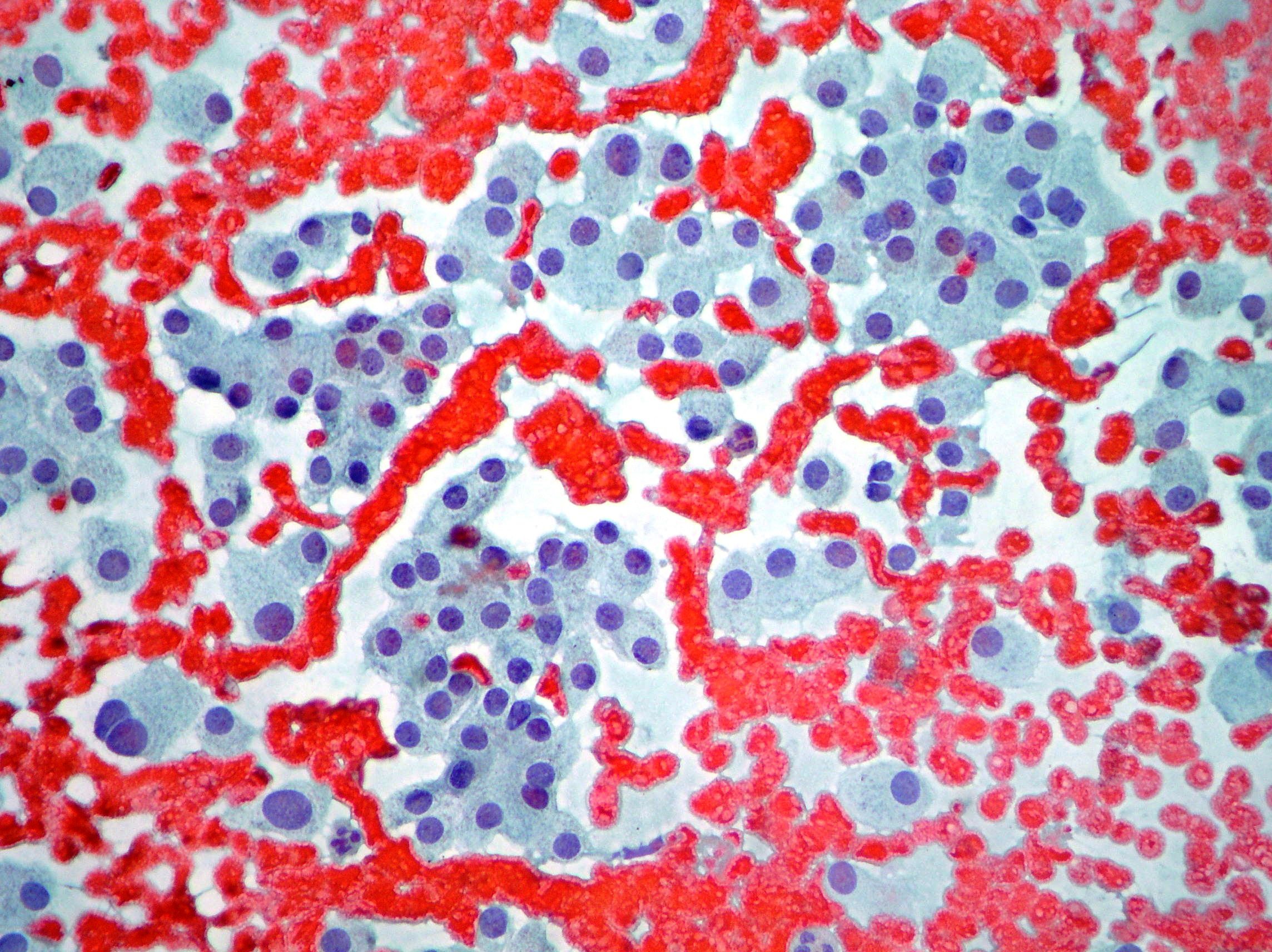 Medullary carcinoma cells