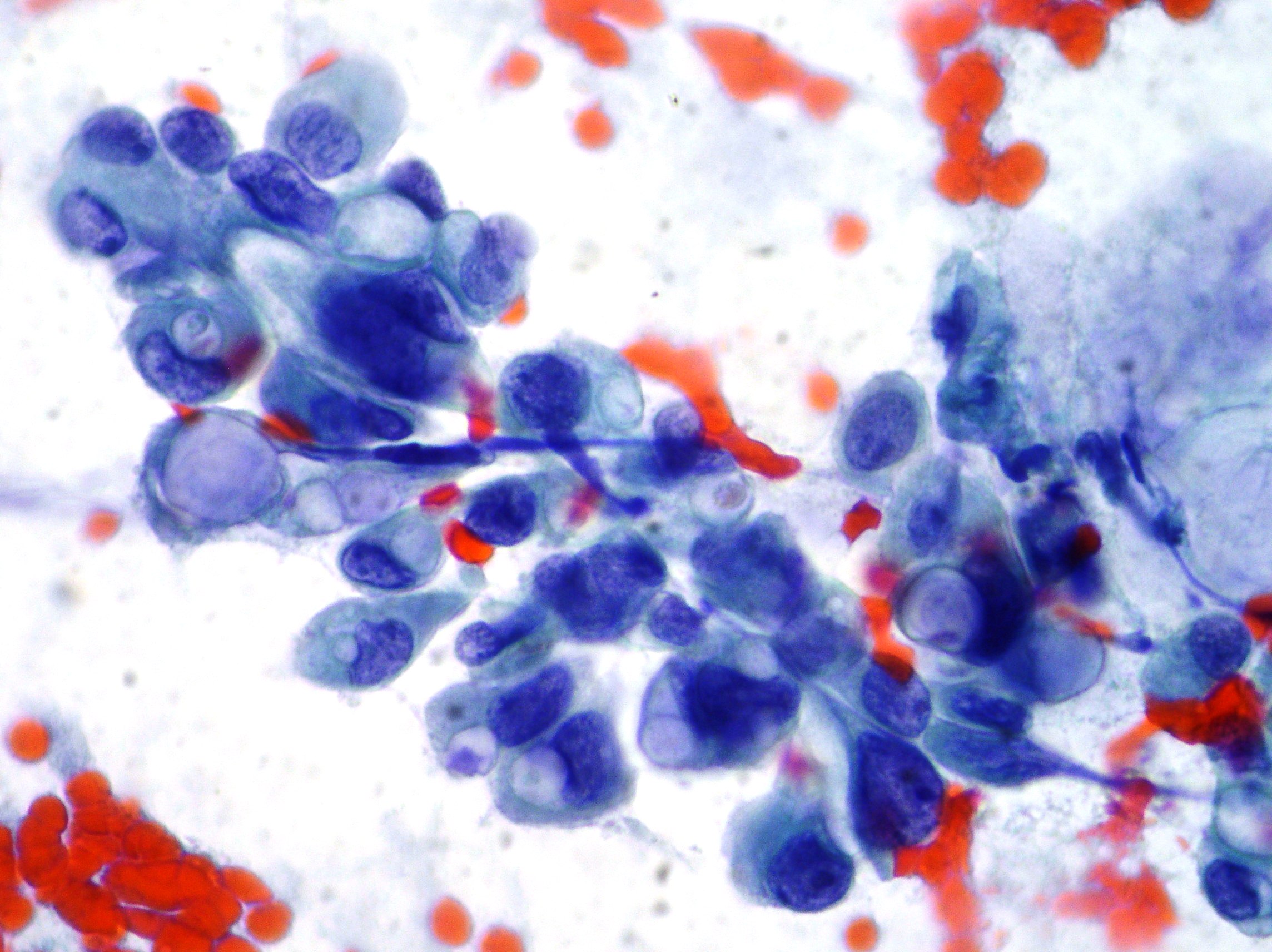 Breast Cytopathology Cellnetpathology