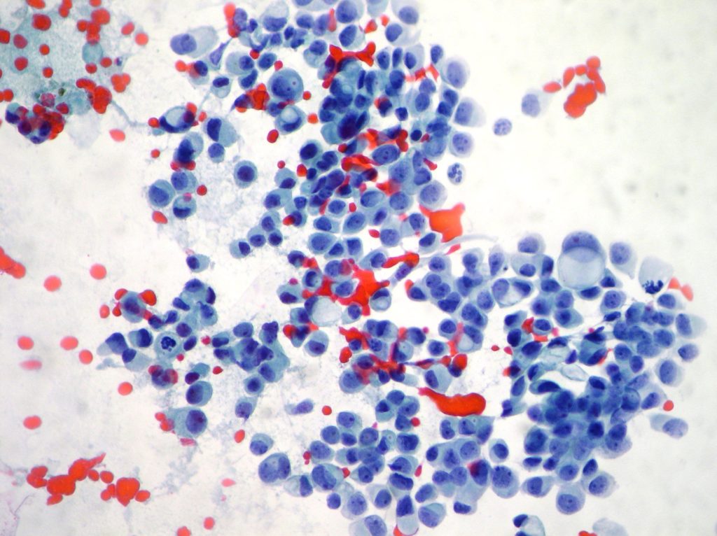 Breast Cytopathology