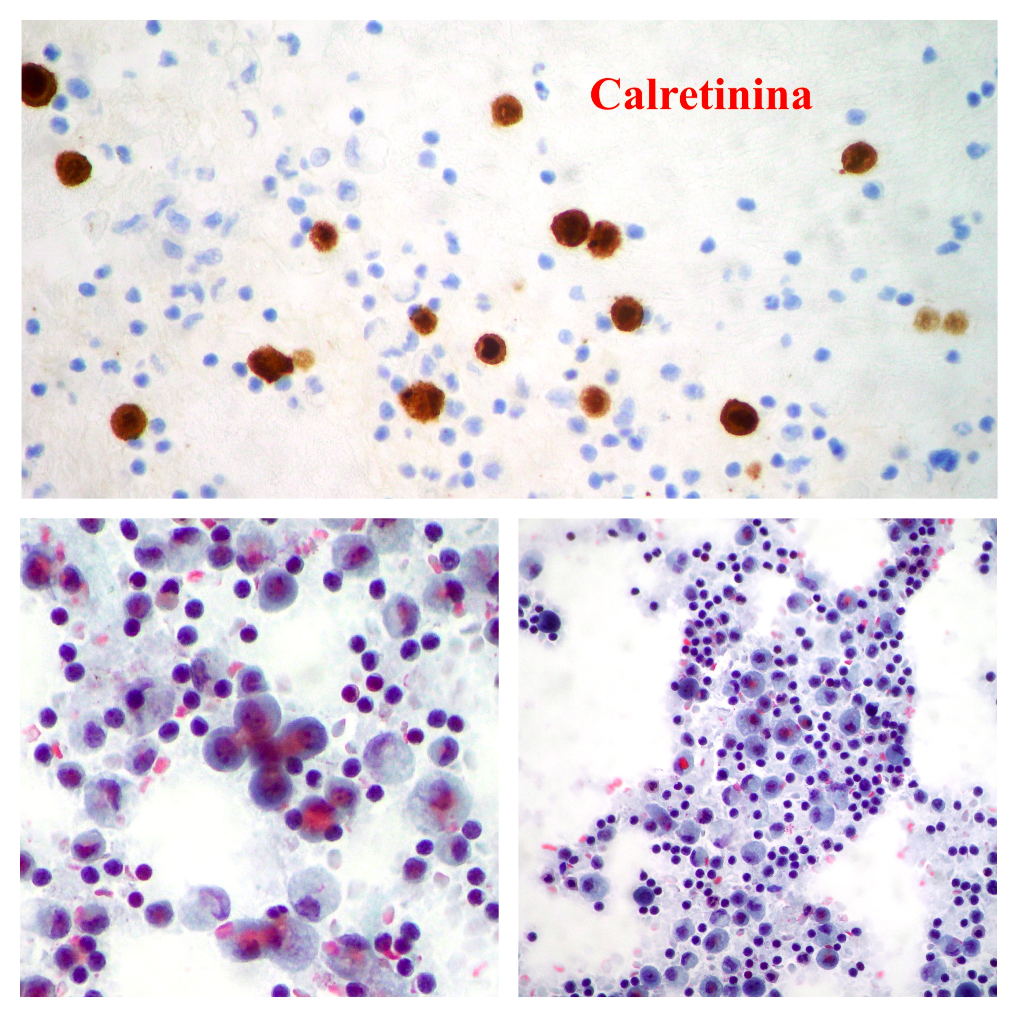 what is the difference between sarcoma and cancer