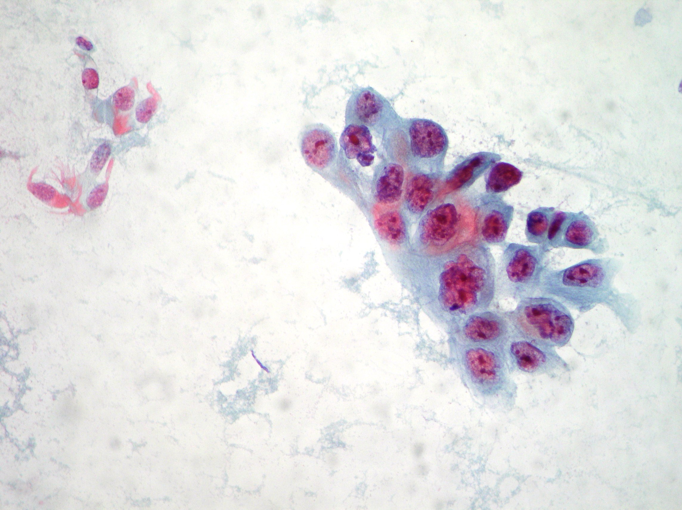 Squamous cell carcinoma and normal cells