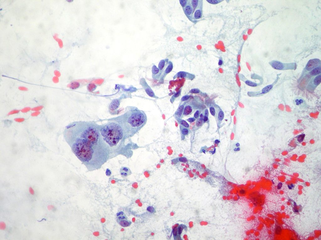 Squamous cell carcinoma and normal cells