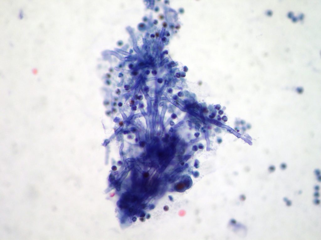 Pulmonary Mycetoma