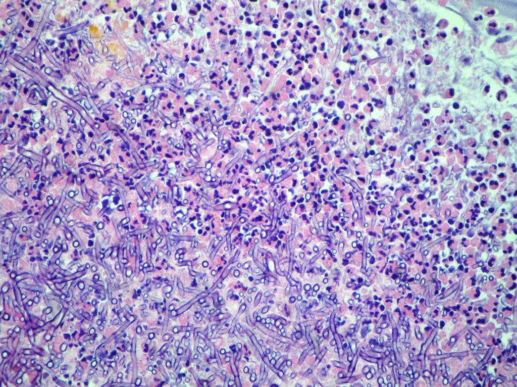 Pulmonary Mycetoma