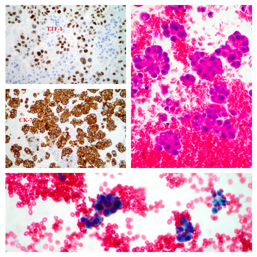 chemotherapy for mesothelioma cancer