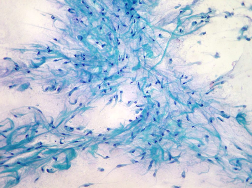 Breast Cytopathology Cellnetpathology