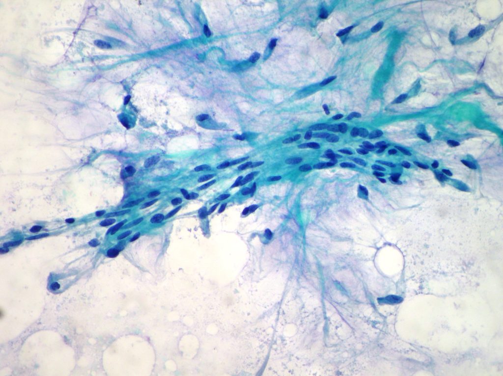 Fibromatous desmoid tumor of the breast