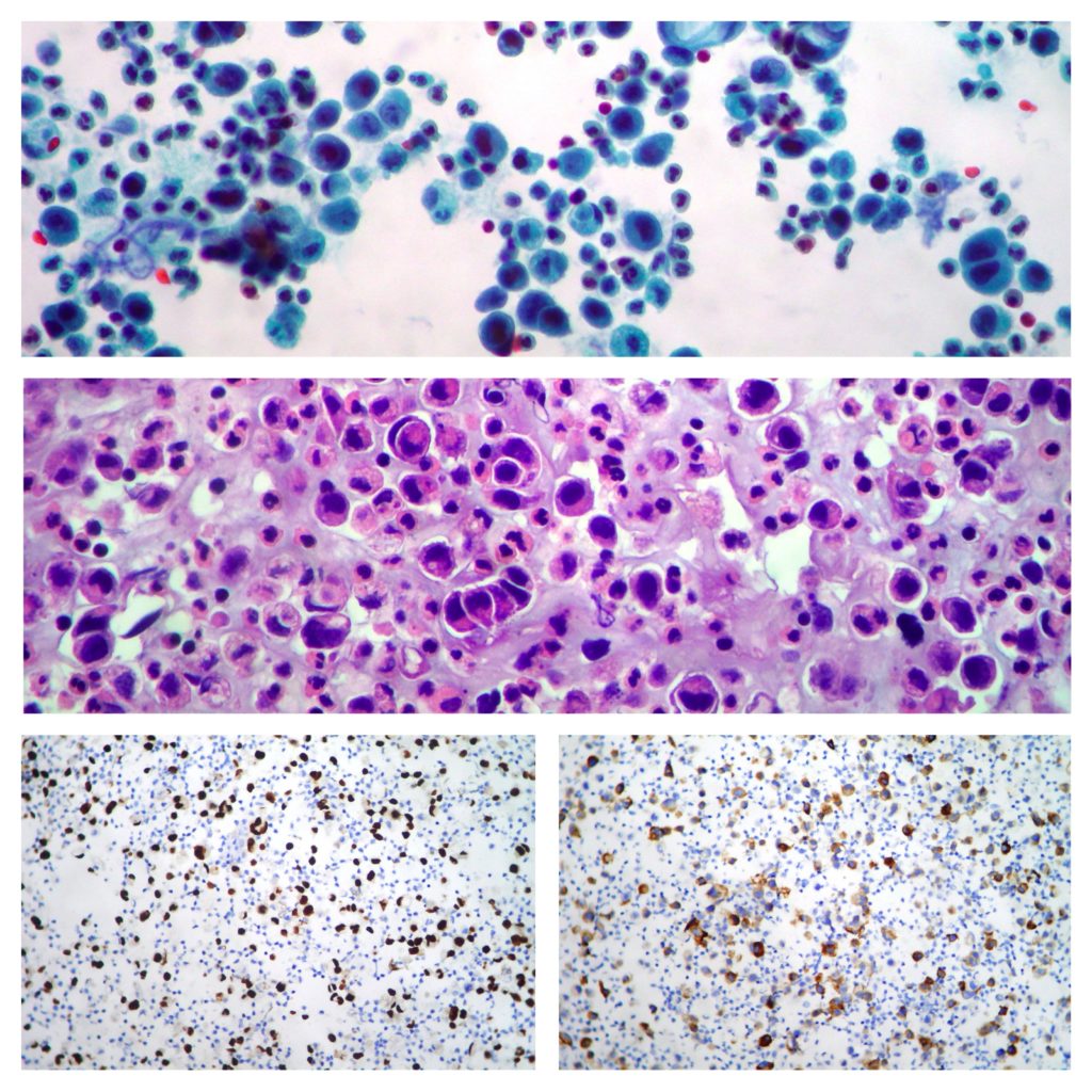 Pleural effusion